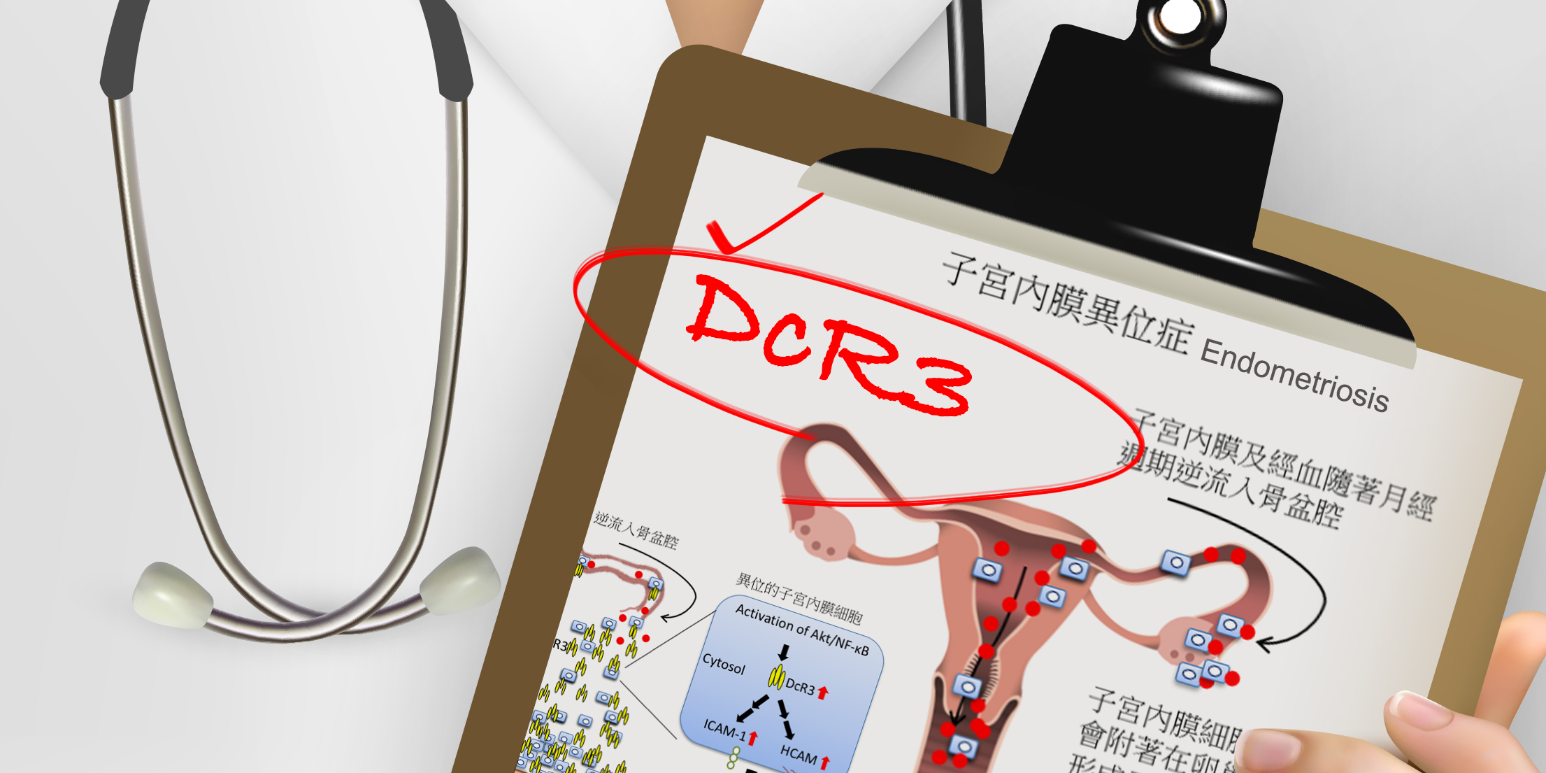 DcR3是造成子宮內膜異位症的原因